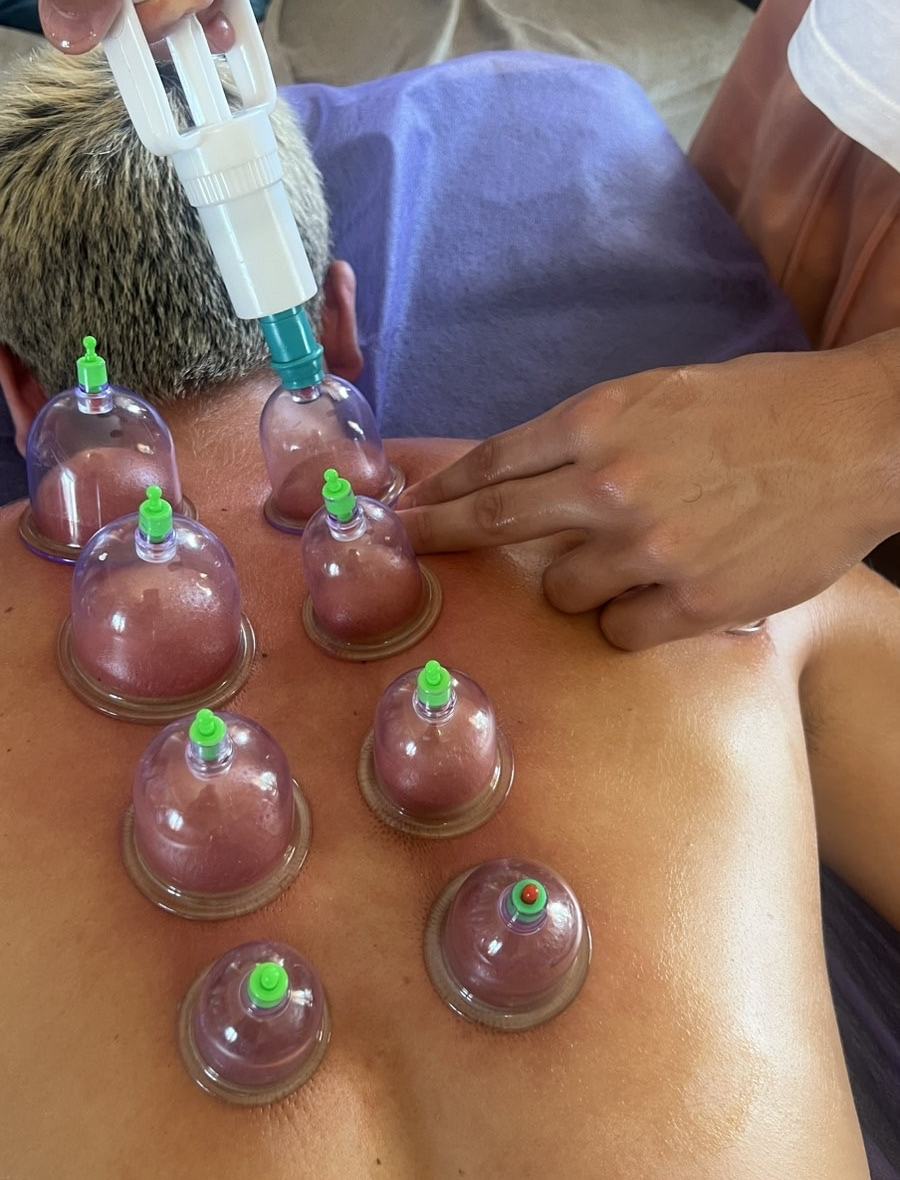 Eight cups placed on selected points of the back, with the air being pumped out of one
